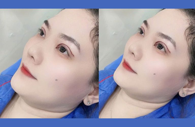 Mí mắt có cảm giác cứng, chưa mềm mại