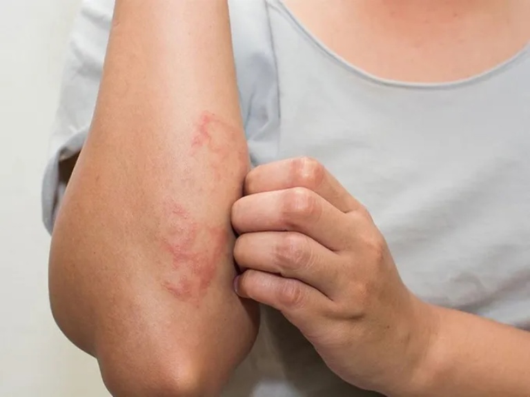 sau cắt mí mắt có ăn khổ qua được không
