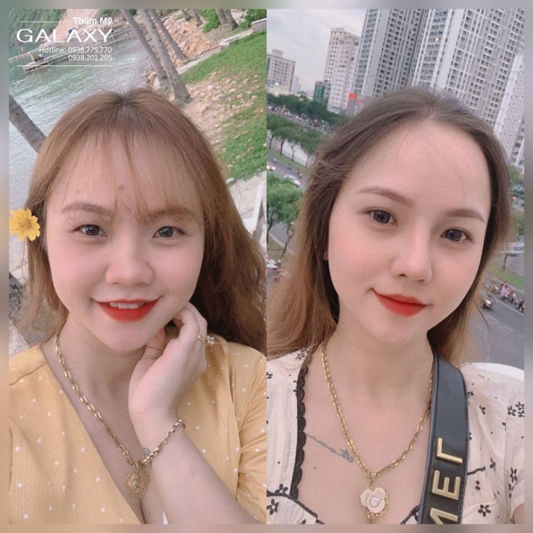 Thẩm mỹ Galaxy tư vấn Sau cắt mí mắt có được ăn chuối không