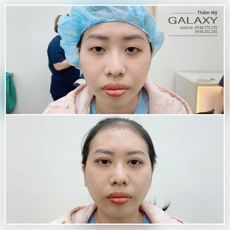 cắt mí mắt có quan hệ tình dục được không