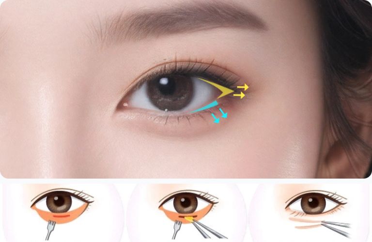 Công nghệ và phương pháp cắt mí