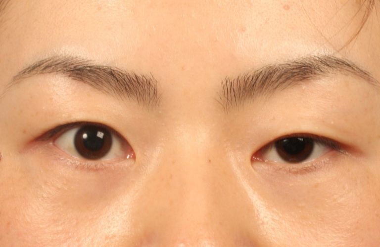Mắt một mí, mí ẩn
