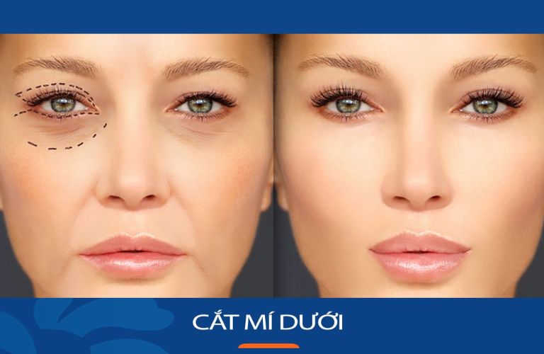 Cắt mí mắt dưới