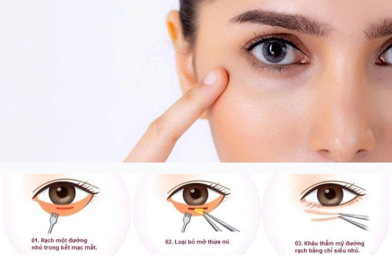 Quy trình cắt mí mắt dưới chuẩn y khoa