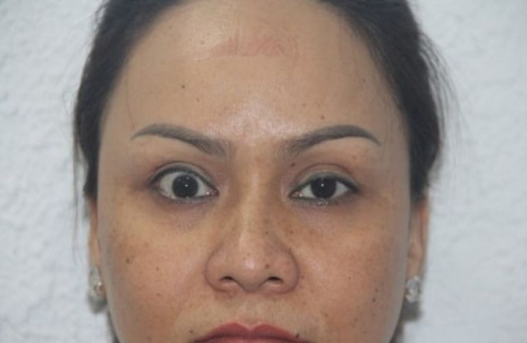 Có thể gặp phải biến chứng