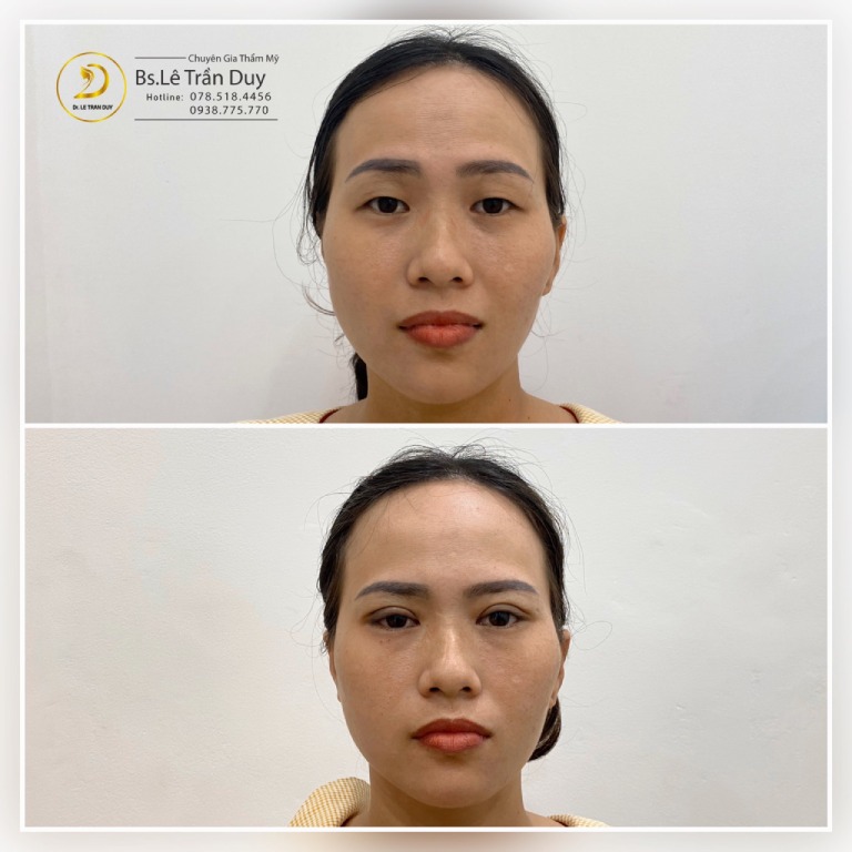 bác sĩ Lê Trần Duy tư vấn cắt mí mắt phải kiêng rau muống bao lâu