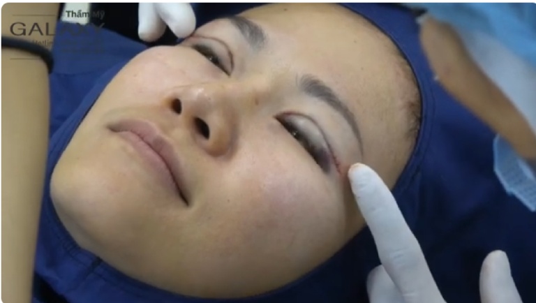 cắt mí mắt lần 2