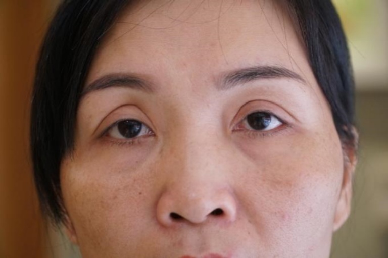 Các yếu tố cần xem xét khi cắt mí mắt lần 2