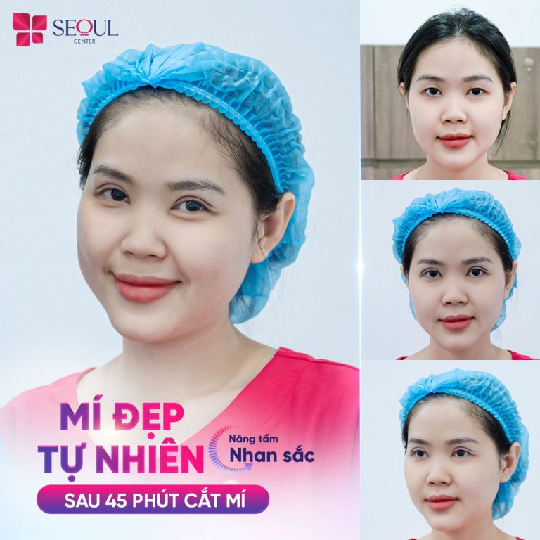 Cắt mí nhanh chóng, không đau, đẹp tự nhiên cùng với Thẩm mỹ viện Seoul Center