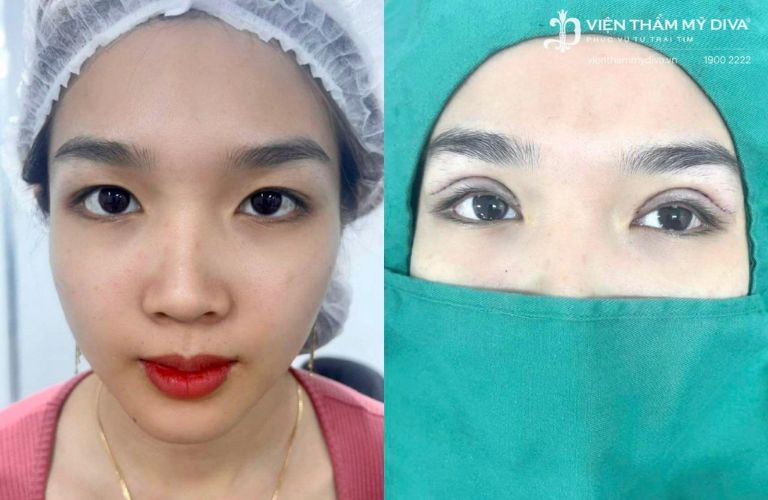 Hình ảnh trước và sau khi cắt mí tại Viện thẩm mỹ Diva