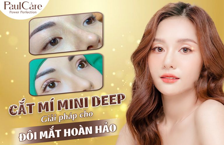 Giải pháp cho đôi mắt hoàn hảo với công nghệ cắt mí mini deep tại Thẩm mỹ viện Paulcare