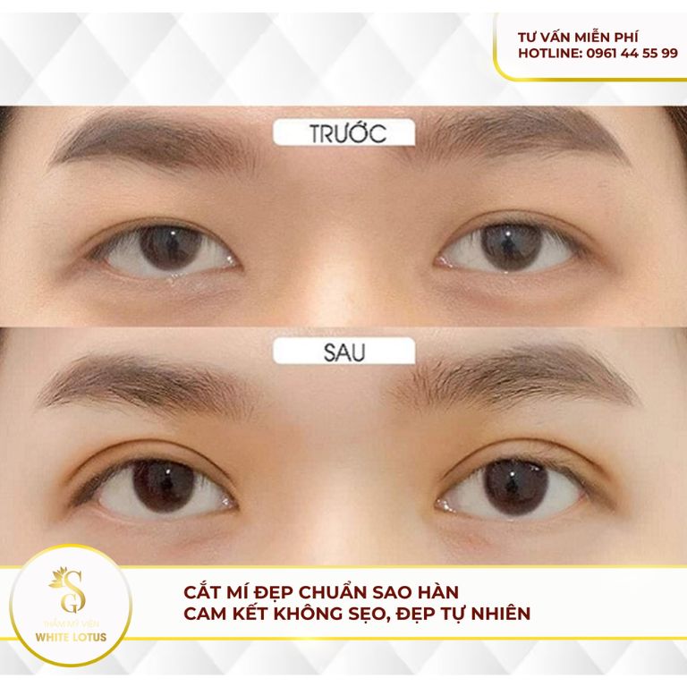 Trước và sau khi cắt mí tại Viện Thẩm Mỹ White Lotus