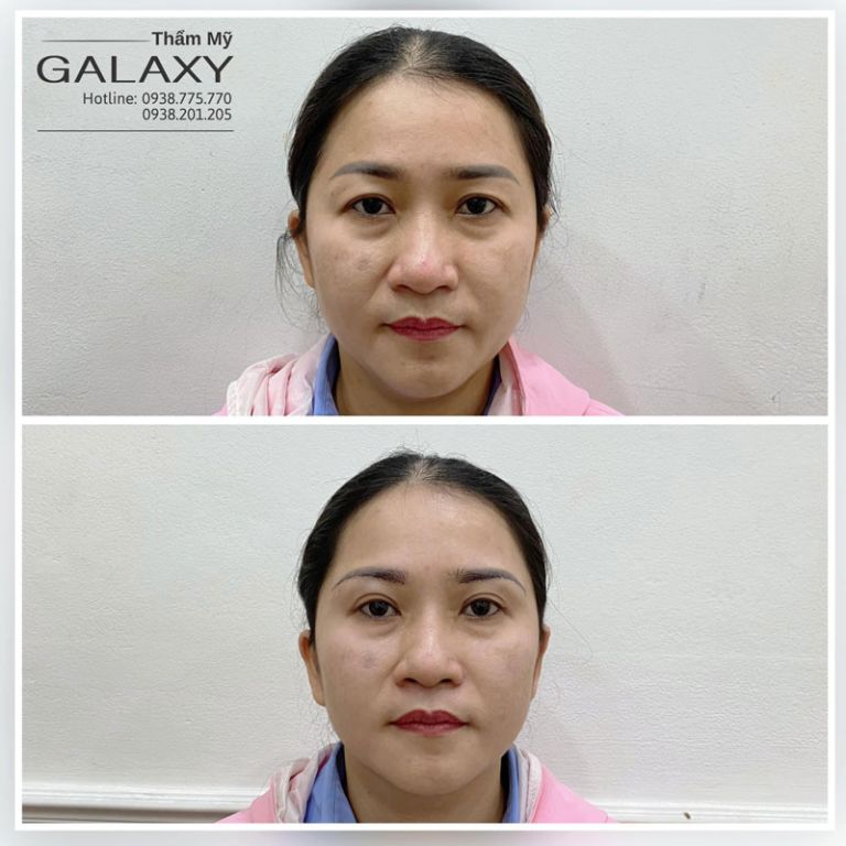 Cắt mí mắt đẹp tự nhiên tại Thẩm mỹ viện Galaxy