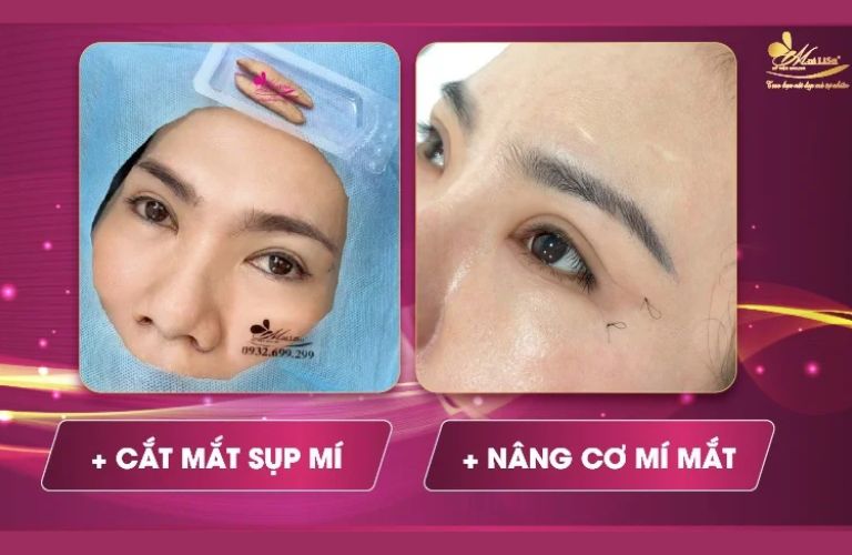 Thẩm Mỹ Viện Mailisa - Địa chỉ thẩm mỹ có uy tín lâu năm, cắt mí mắt đẹp