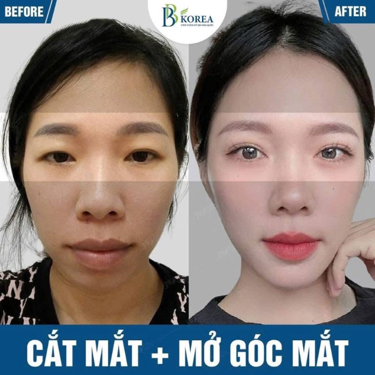 Trước và sau khi thẩm mỹ mắt tại Viện Thẩm Mỹ BB KOREA