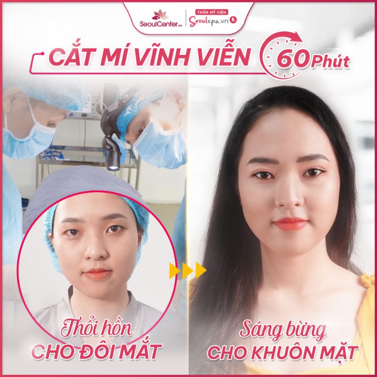 Cắt mí mắt đẹp và nhanh chóng với Thẩm mỹ viện Seoul Center