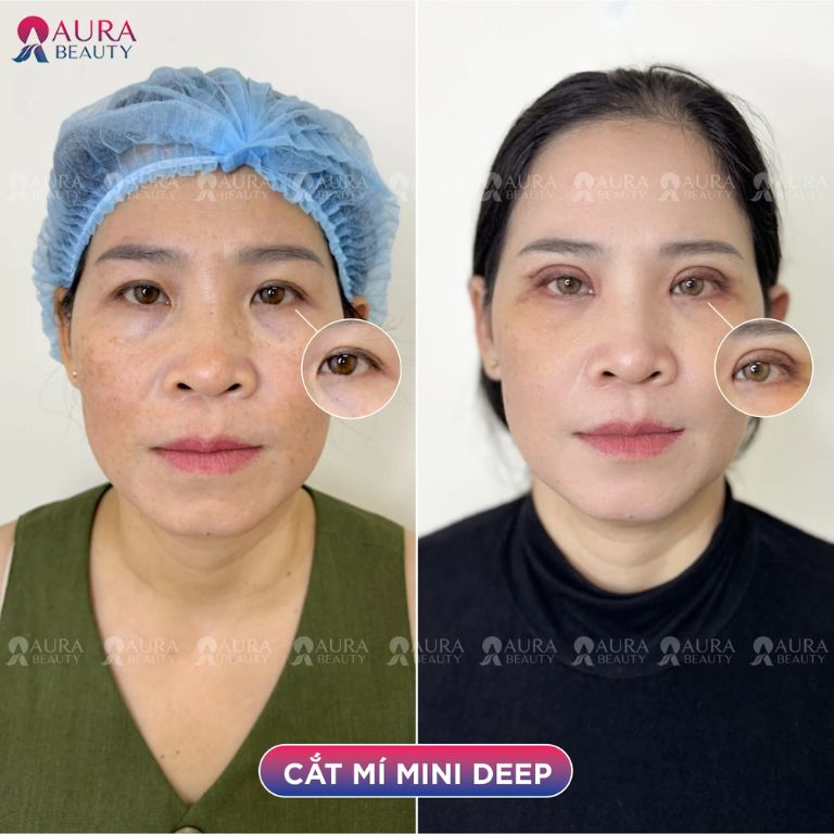 Phương pháp cắt mí mắt mini deep tại Thẩm mỹ viện quốc tế Aura