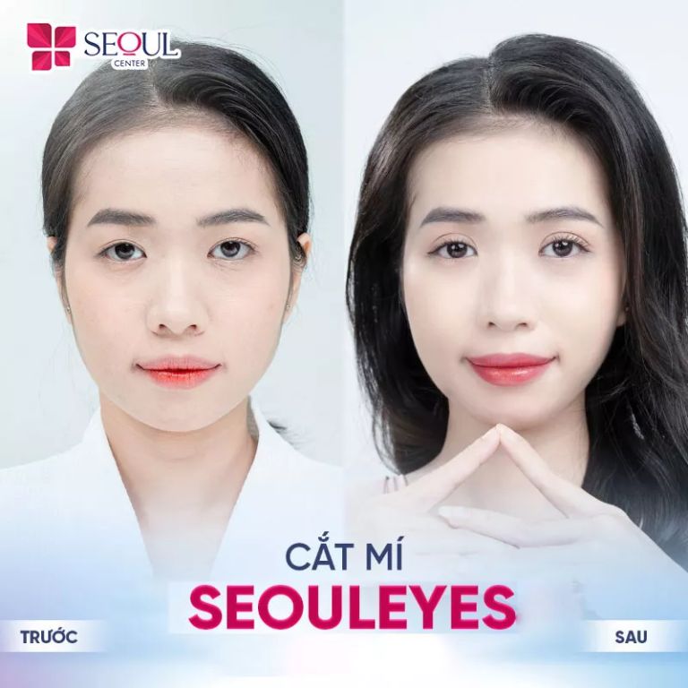 Cắt mí mắt Seouleyes tại Thẩm mỹ viện Seoul Center cho đôi mắt to, đều và đẹp