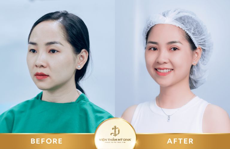 Gương mặt rạng rỡ, ánh mắt cuốn hút hơn sau khi cắt mí mắt tại Viện thẩm mỹ Diva