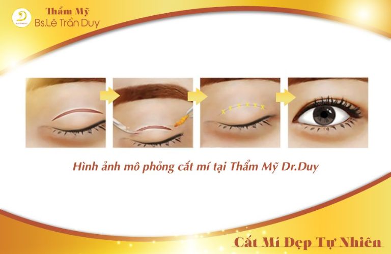 Mô phỏng quy trình cắt mí mắt tại Thẩm mỹ viện Galaxy