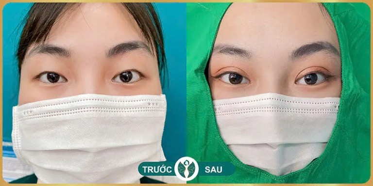 địa chỉ cắt mí mắt đẹp ở tphcm Thẩm Mỹ NAKiSA