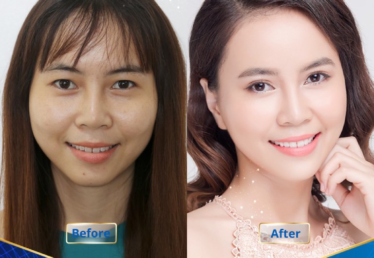 cắt mí mắt ở Bệnh Viện Thẩm Mỹ Thanh Vân