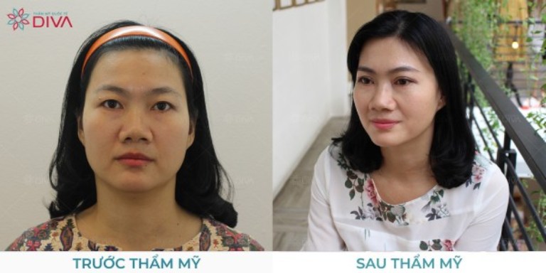 cắt mí mắt ở Phòng Khám Thẩm Mỹ Diva tại TPHCM