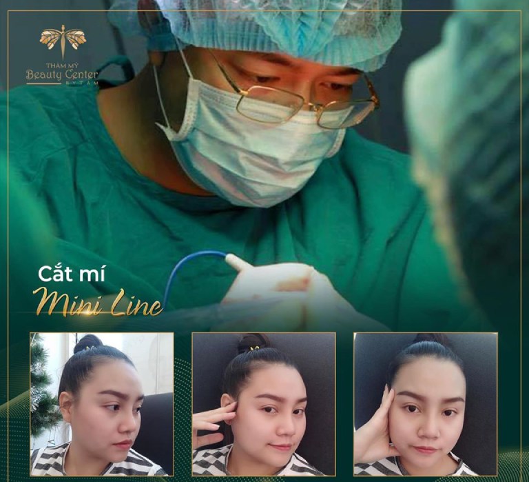 cắt mí mắt tại Thẩm mỹ viện Tấm TPHCM