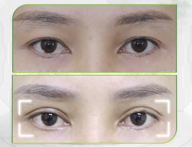 cắt mí mắt tại Thẩm mỹ Saigon Venus TPHCM