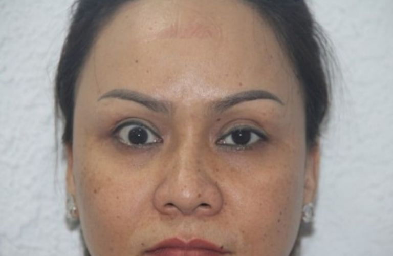 Cắt mí mắt quá dài có thể gây mất cân đối