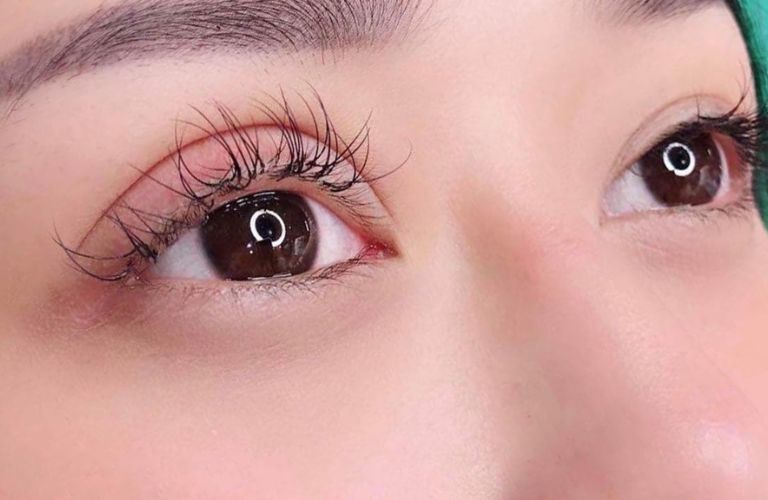 Vì sao cắt mí mắt bị sâu? Các phương pháp khắc phục
