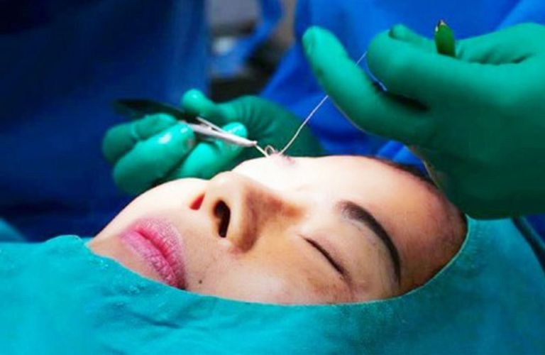 Cắt mí quá nhiều da hoặc mỡ