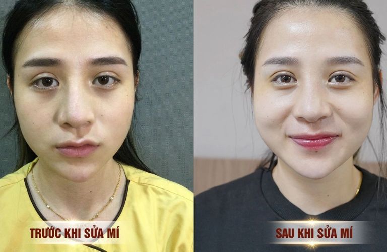 Chỉnh sửa phẫu thuật lần 2