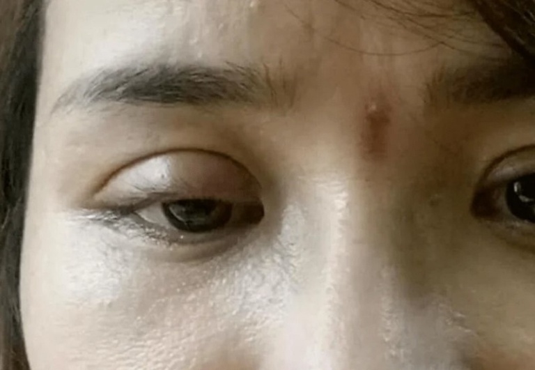 Cắt mí mắt quá to có sao không