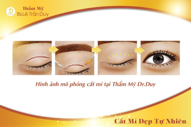 quy trình sửa cắt mí mắt quá to tại Thẩm mỹ galaxy