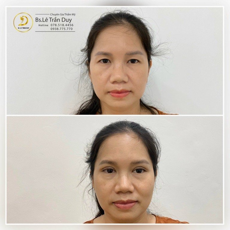 chỉnh sửa cắt mí mắt quá to tại Thẩm mỹ Galaxy
