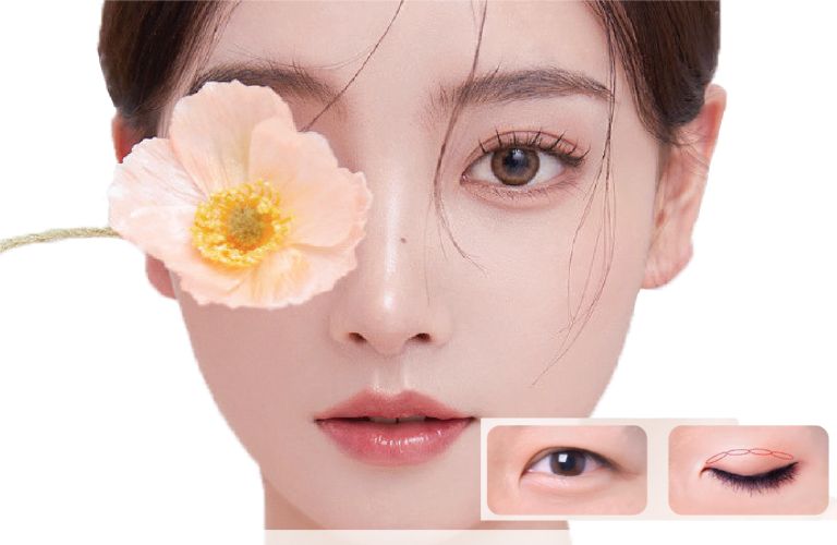 Cắt mí sau 3 tháng đẹp chưa?
