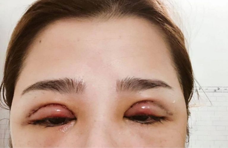 Sưng tấy, bầm tím và đau nhức là dấu hiệu thường thấy sau phẫu thuật cắt mí