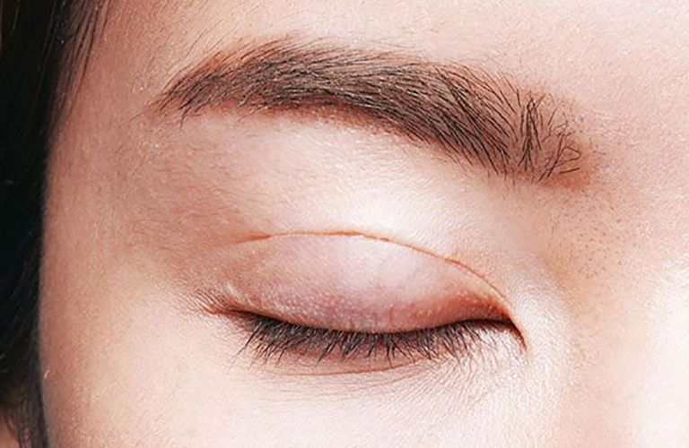 Sẹo lồi hoặc thâm