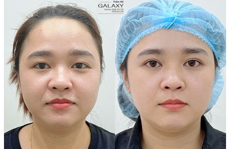 Cắt mí đẹp, phục hồi nhanh với bác sĩ Lê Trần Duy tại Thẩm mỹ viện Galaxy