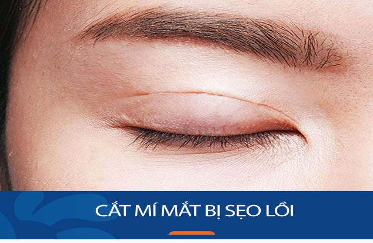 Cắt mí bị sẹo lồi nếu thực hiện sai kỹ thuật hoặc chăm sóc không đúng cách