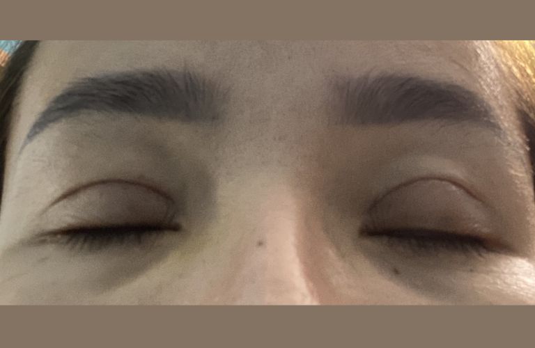 Mí mắt không đều có thể xảy ra nếu thực hiện sai kỹ thuật, bác sĩ thiếu chuyên nghiệp