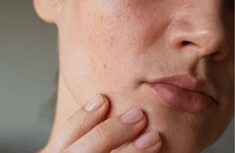 Người từ 35 tuổi trở lên, có làn da chảy xệ từ nhẹ đến vừa