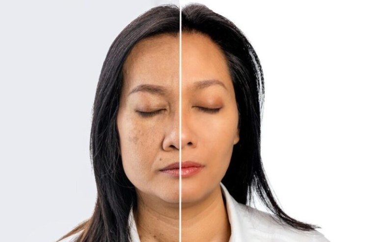 Những yếu tố cần cân nhắc trước khi quyết định có nên căng da mặt không