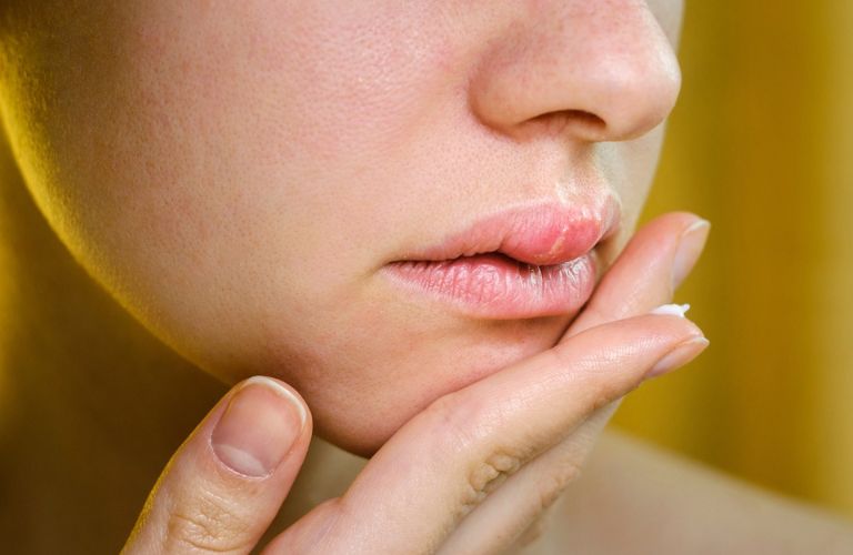 Môi sưng nề kéo dài hơn 3 ngày