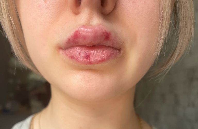Màu môi loang lổ, không đều, thâm xỉn sau khi bong vảy