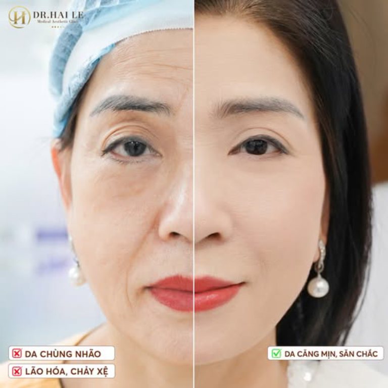 Viện Thẩm Mỹ Y Khoa Dr.Hải Lê là địa chỉ căng da mặt tphcm chất lượng