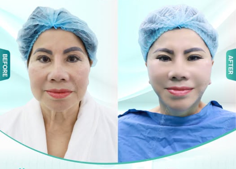 Phòng Khám Chuyên Khoa Thẩm Mỹ Mona là địa chỉ căng da mặt chuyên nghiệp tại tphcm