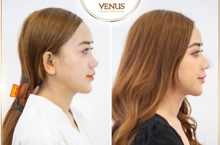 Thẩm mỹ Venus nâng mũi tại Bà Rịa – Vũng Tàu.