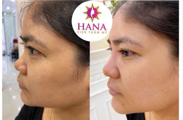 Nâng mũi tự nhiên tại Viện thẩm mỹ Dr. Hana Bà Rịa – Vũng Tàu.